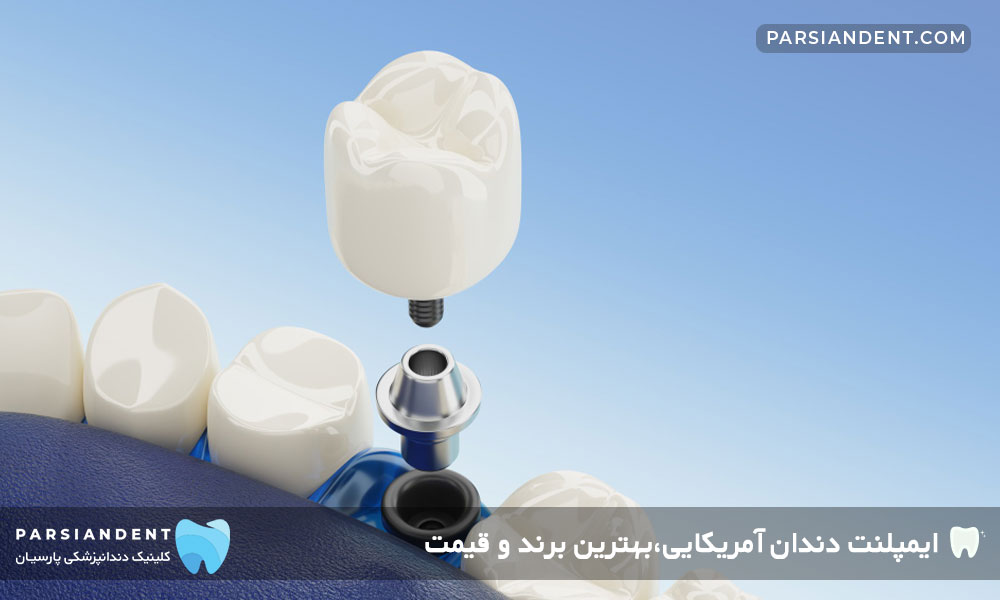 ایمپلنت دندان آمریکایی