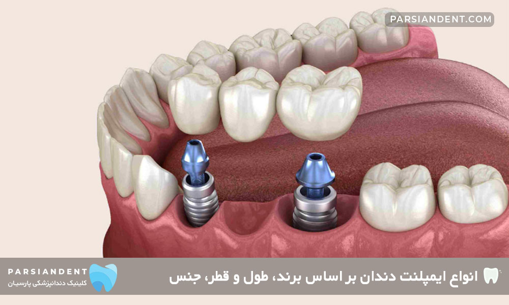 قیمت انواع ایمپلنت دندان