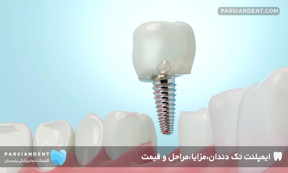 ایمپلنت تک دندان