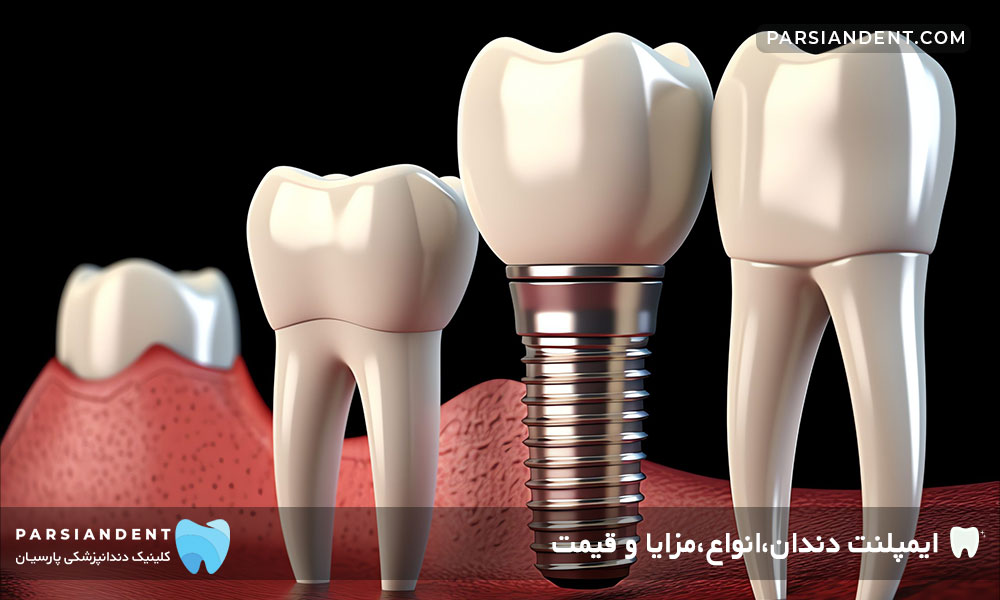 مزایا و معایب ایمپلنت دندان