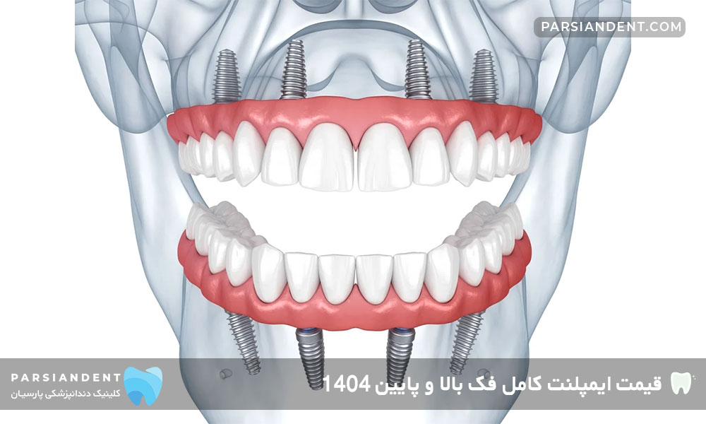 ایمپلنت کامل فک بالا و پایین