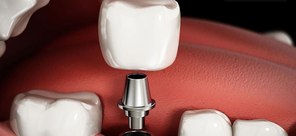 روکش موقت ایمپلنت دندان،مزایا و معایب و قیمت