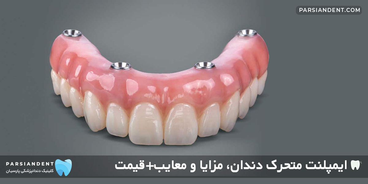 قیمت ایمپلنت متجرک