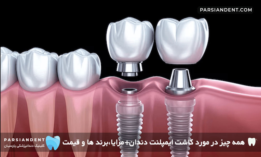 مزایای کاشت ایمپلنت دندان
