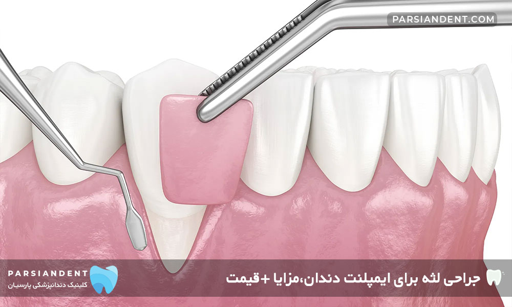 مزایای جراحی لثه برای ایمپلنت دندان