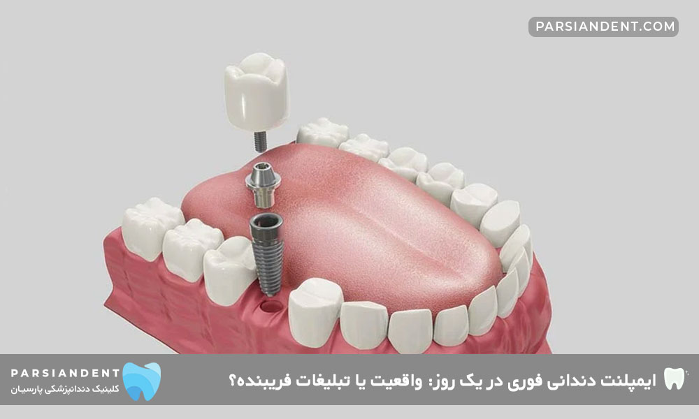 مزایای ایمپلنت دندانی فوری در یک روز 