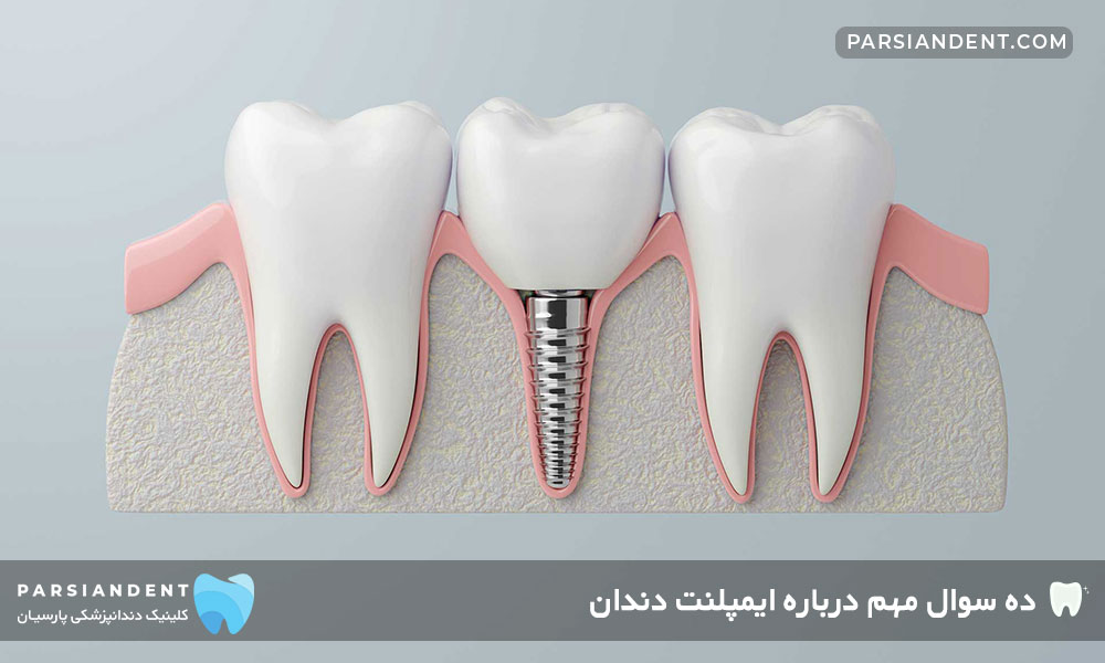 سوال مهم درباره ایمپلنت دندان