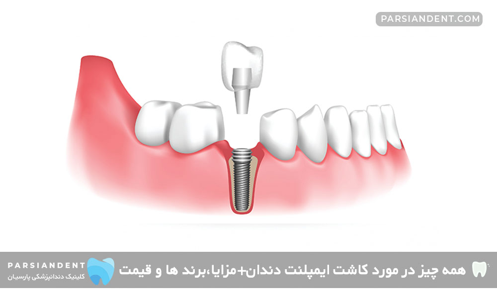 همه چیز در مورد کاشت ایمپلنت دندان