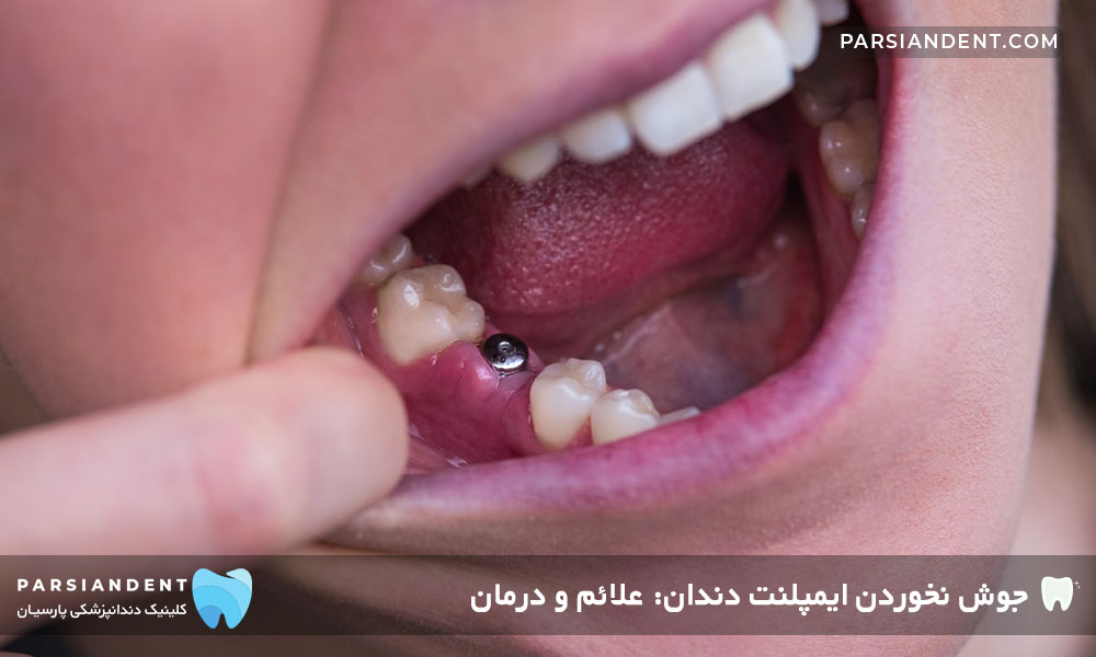 علائم جوش نخوردن ایمپلنت دندان