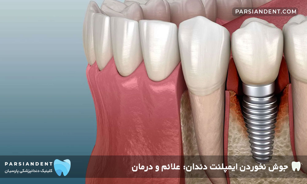 جوش نخوردن ایمپلنت دندان: علائم و درمان