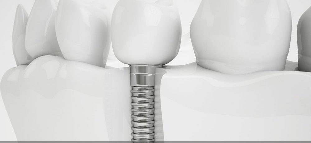 قیمت کاشت دندان ۱۴۰۴