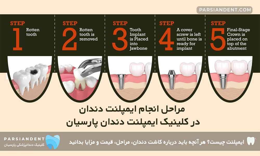 مراحل انجام ایمپلنت دندان در کلینیک ایمپلنت دندان پارسیان