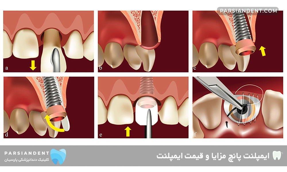 ایمپلنت پانچ مزایا و قیمت ایمپلنت