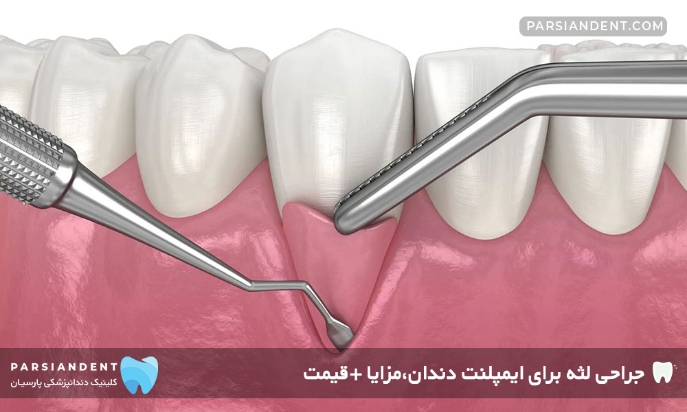 جراحی لثه برای ایمپلنت دندان