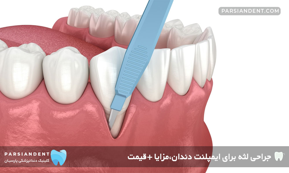 قیمت جراحی لثه برای ایمپلنت دندان