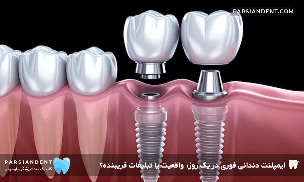 ایمپلنت دندانی فوری 