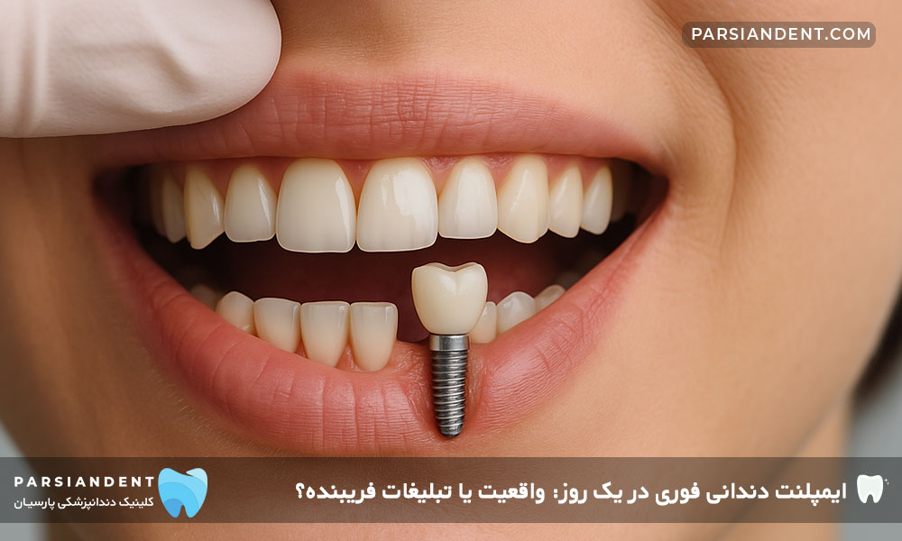 ایمپلنت دندانی فوری