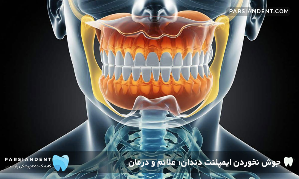 دلایل جوش نخوردن ایمپلنت دندان