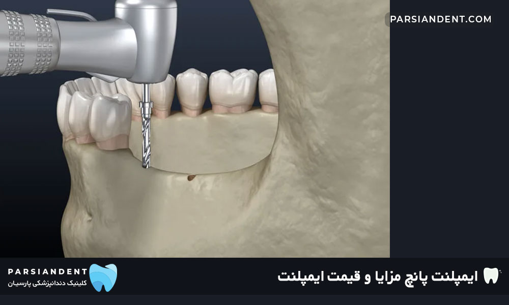 ایمپلنت پانچ مزایا و قیمت ایمپلنت
