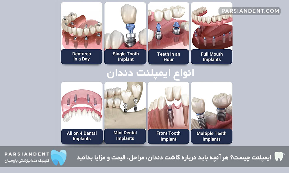 انواع ایمپلنت دندان-کلینیک ایمپلنت دندان