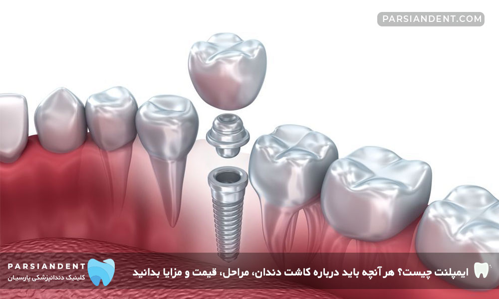 ایمپلنت چیست؟
