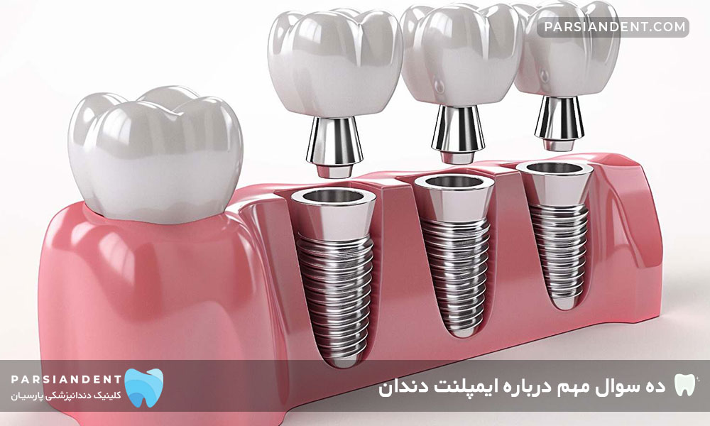 10 سوال مهم درباره ایمپلنت دندان