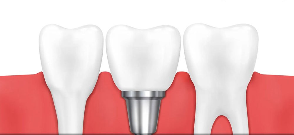 راهنمای کامل کاشت دندان طبیعی در سال ۱۴۰۴