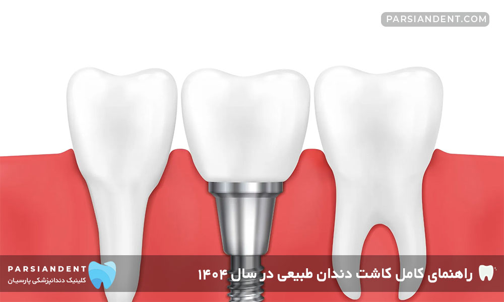 راهنمای کامل کاشت دندان طبیعی در سال ۱۴۰۴
