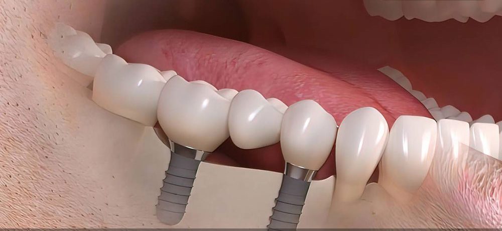 راهنمای کامل کاشت دندان