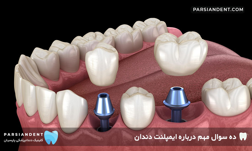 سوالات رایج ایمپلنت دندان