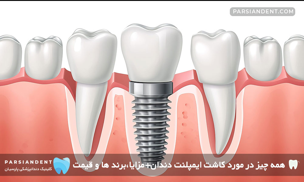 قیمت کاشت ایمپلنت دندان