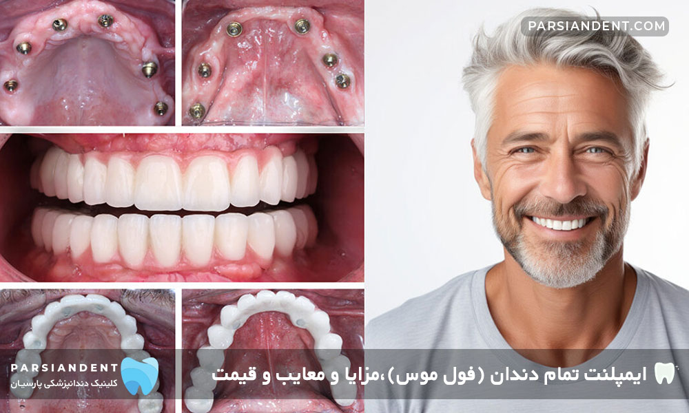 مزایای ایمپلنت تمام دندان