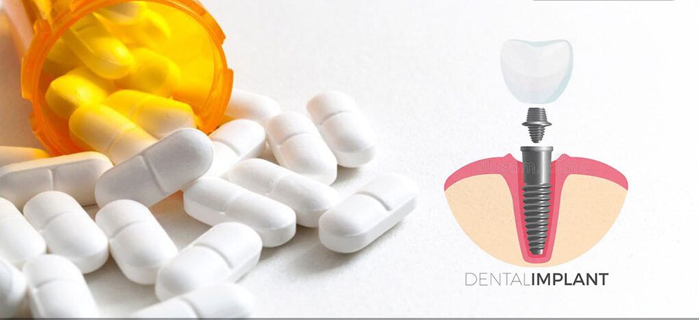 قیمت داروهای ایمپلنت دندان