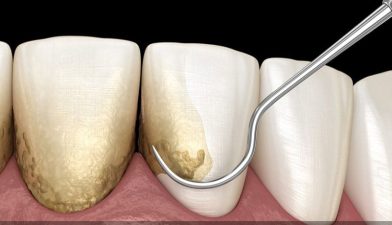 جرم‌گیری ایمپلنت دندان