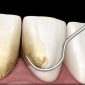 Dental implant scaling e1760959652753 85x85