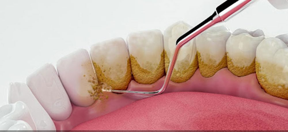 هزینه جرمگیری ایمپلنت دندان