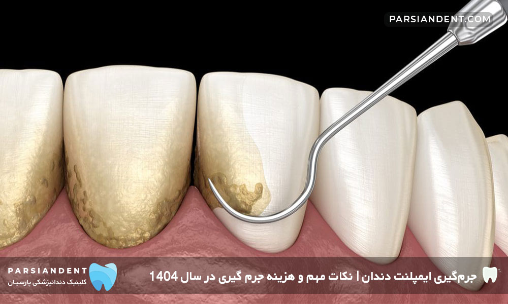 جرمگیری ایمپلنت دندان