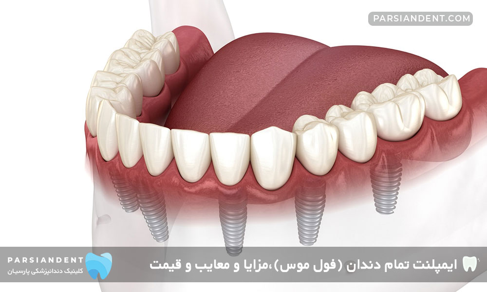 قیمت ایمپلنت تمام دندان فول موس