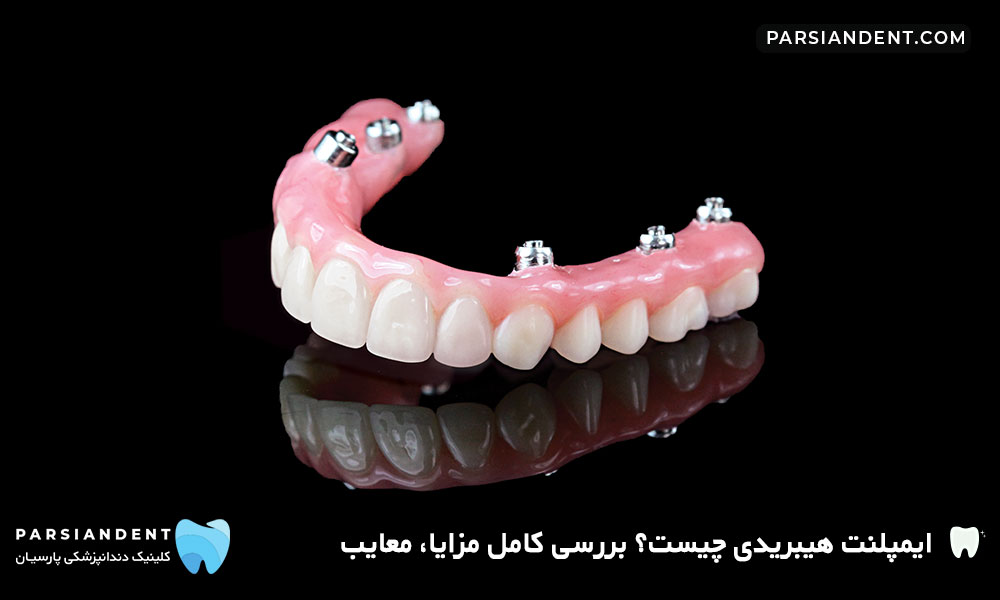 قیمت ایمپلنت هیبریدی