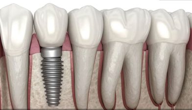 ایمپلنت تک مرحله‌ای