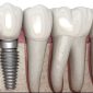 One Stage Dental Implant e1760627023359 85x85
