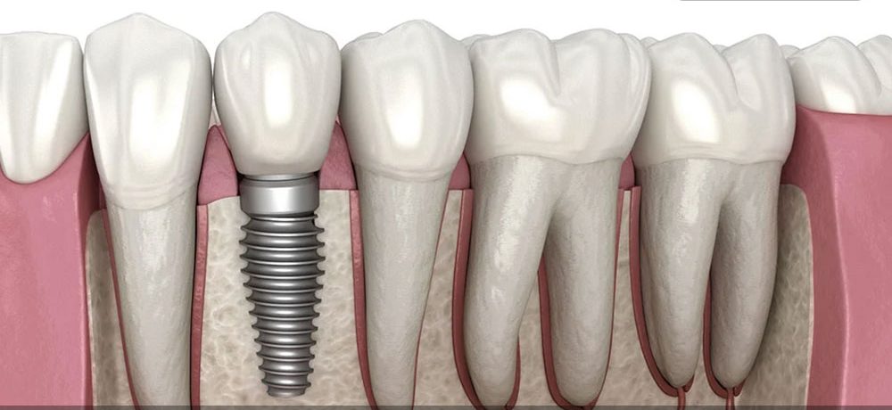 ایمپلنت تک مرحله‌ای