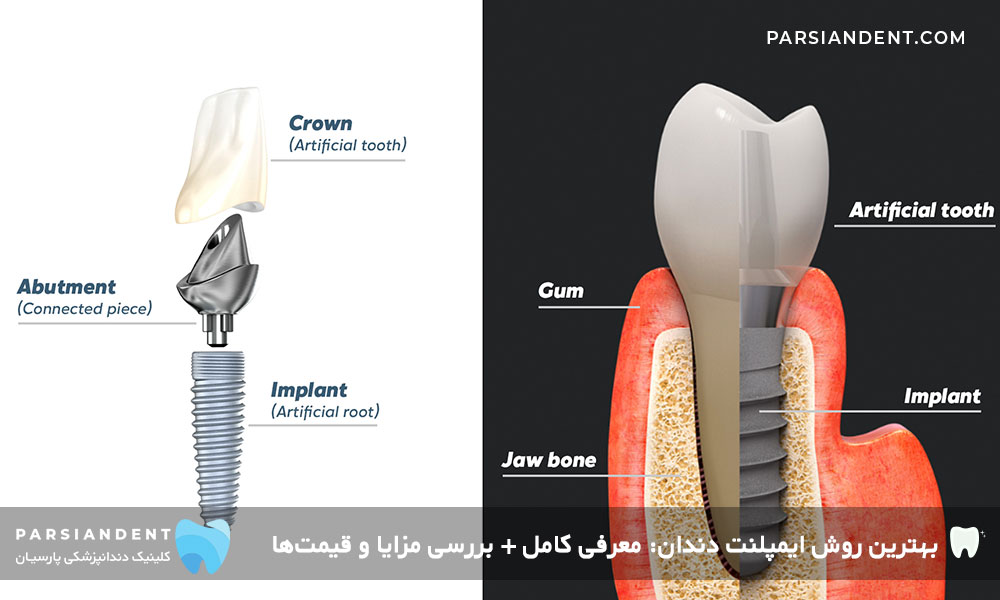 قیمت بهترین روش ایمپلنت دندان