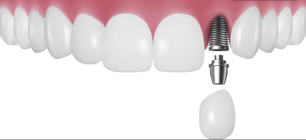 قیمت ایمپلنت تک مرحلهای