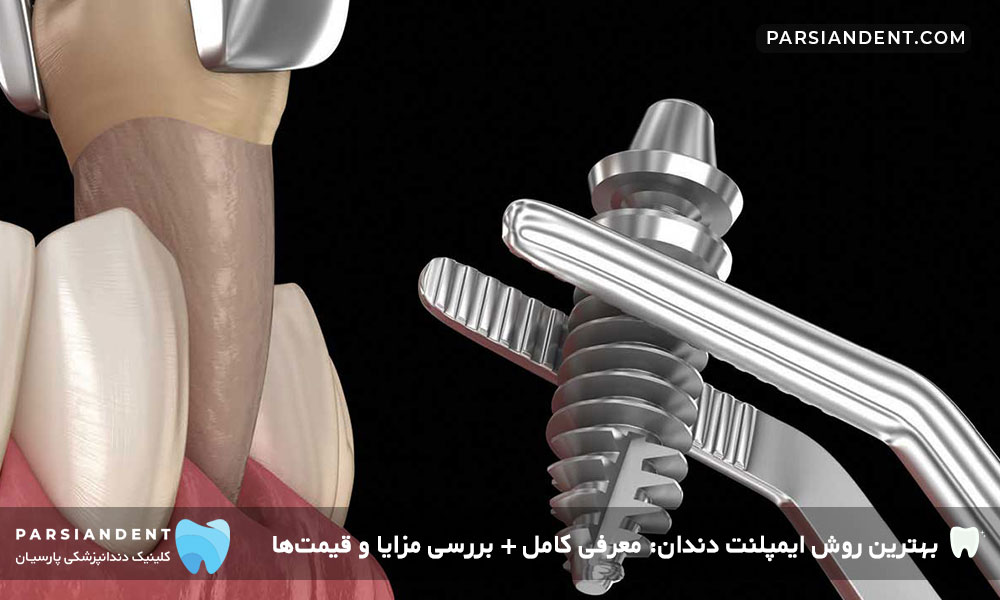 ایمپلنت فوری دندان-بهترین روش کاشت دندان