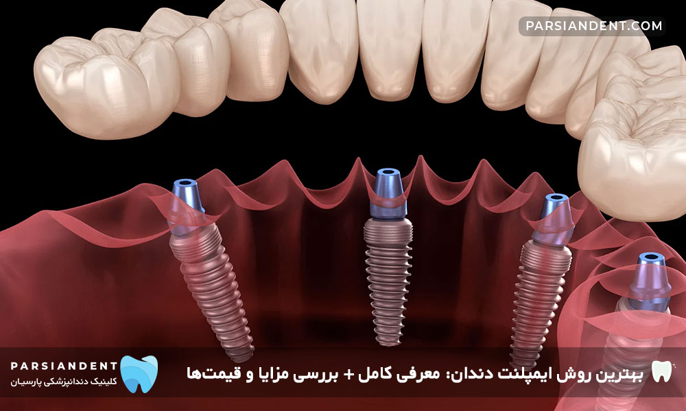 ایمپلنت All-on-4-بهترین روش ایمپلنت