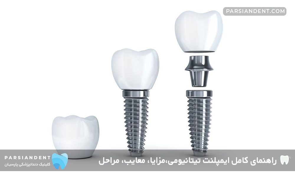 مزایای ایمپلنت تیتانیومی