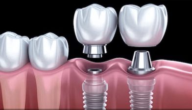 ایمپلنت ارزان