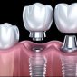 dental implant cheap e1760628984735 85x85