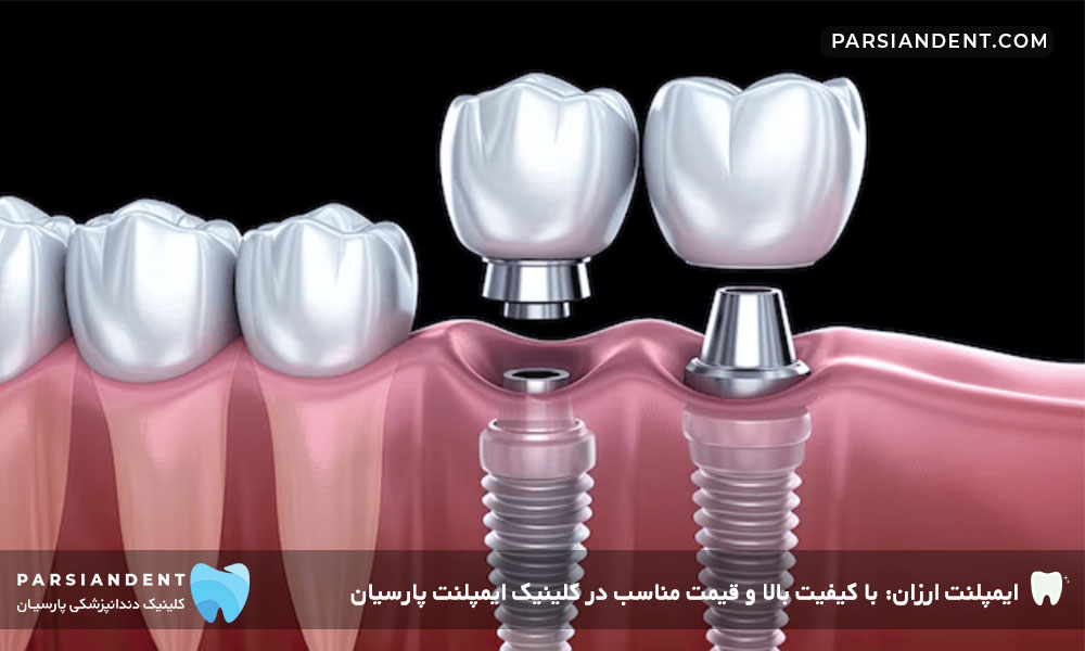 ایمپلنت ارزان